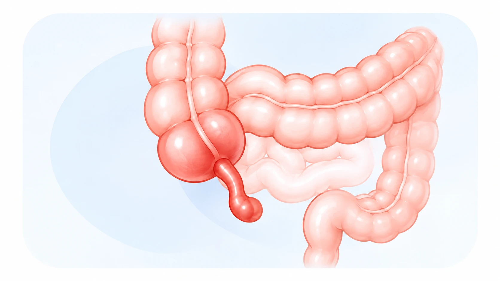 맹장과 그 끝에 연결된 충수를 확대한 해부 일러스트
